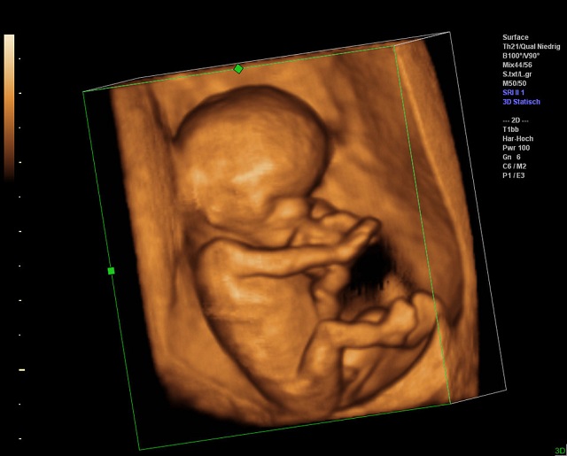 ecografia 3D in gravidanza