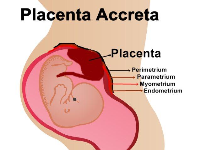 placenta_Accreta_patologia