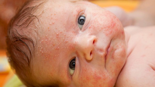 foto_acne neonatale