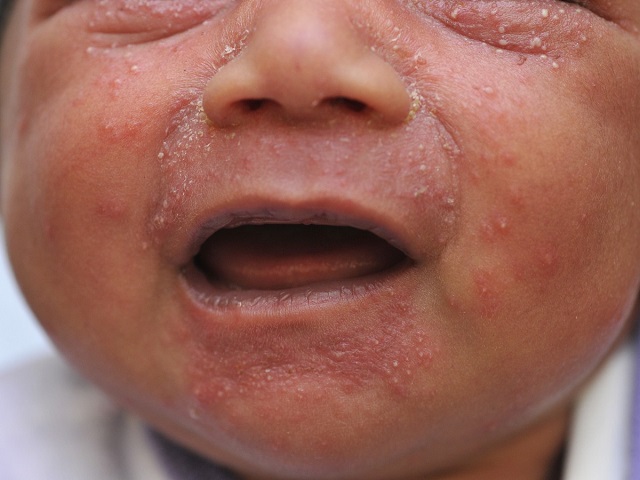 foto_acne neonatale