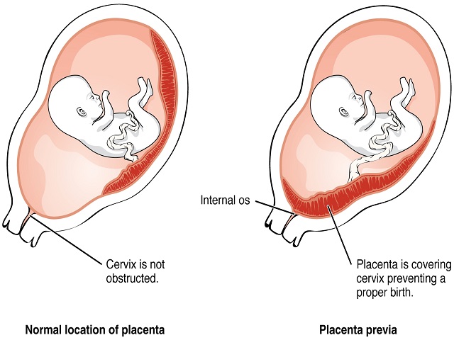 foto_placenta_previa