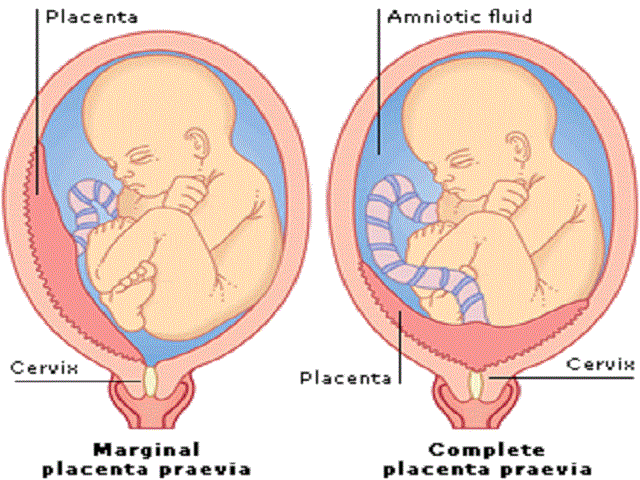 foto_placenta _previa_marginale_e_centrale