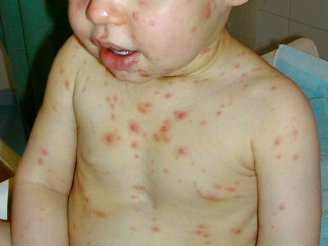 varicella bambini