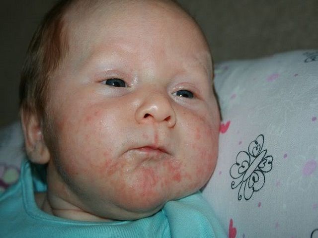 sesta malattia viso neonato