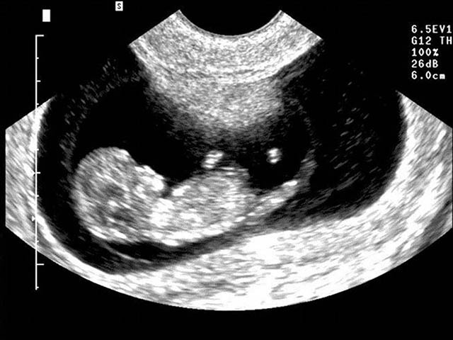 Foto ecografia feto 10 settimane gravidanza