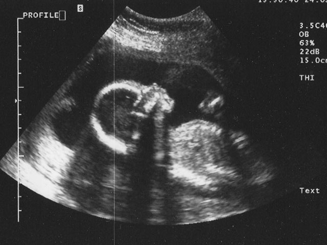 Foto ecografia feto 11 settimane gravidanza