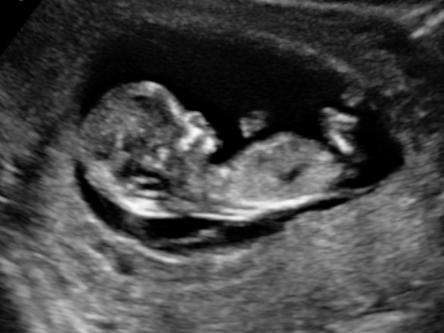 Foto ecografia feto 12 settimane gravidanza
