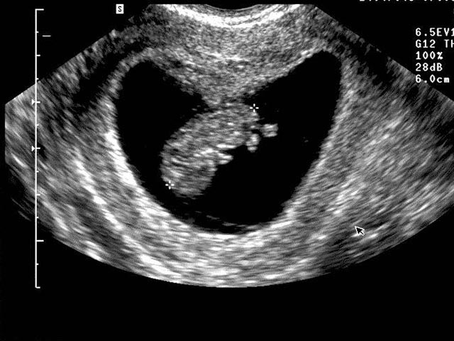 Foto ecografia feto 9 settimane gravidanza