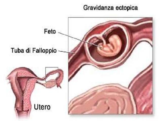 foto gravidanza extrauterina