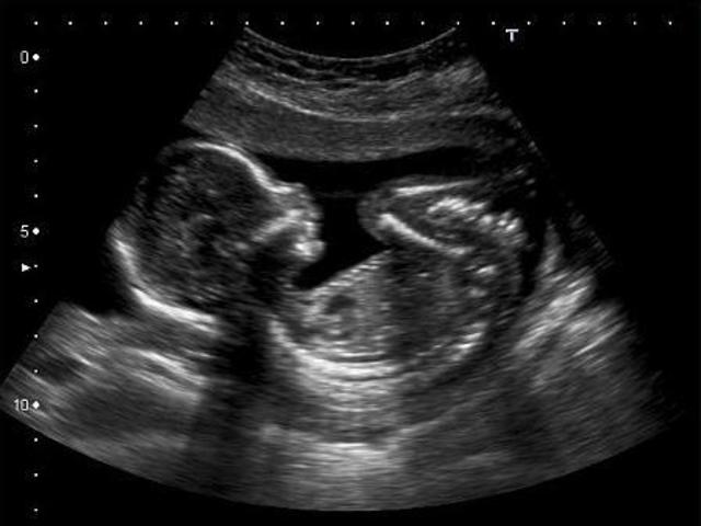 feto-a-18-settimane